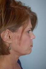Mid Face Lift