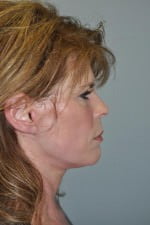 Mid Face Lift
