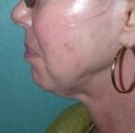 Mid Face Lift