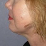 Mid Face Lift