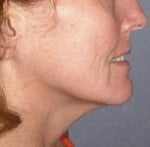 Mid Face Lift
