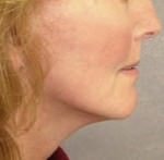 Mid Face Lift