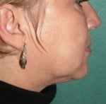 Mid Face Lift