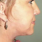 Mid Face Lift