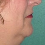 Neck Lift