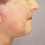 Neck Lift
