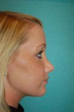 Revision Rhinoplasty