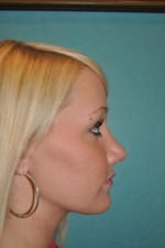 Revision Rhinoplasty