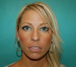 Rhinoplasty
