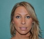 Rhinoplasty