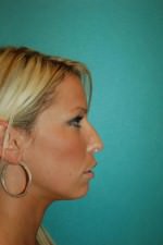 Rhinoplasty