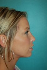 Rhinoplasty