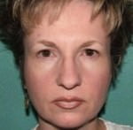 Rhinoplasty