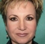 Rhinoplasty