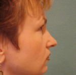 Rhinoplasty