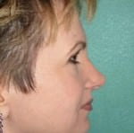 Rhinoplasty