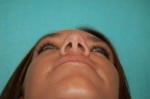 Rhinoplasty