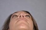 Rhinoplasty