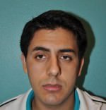 Rhinoplasty