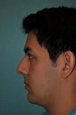 Rhinoplasty