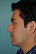 Rhinoplasty