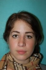 Rhinoplasty
