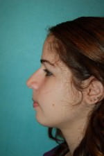 Rhinoplasty
