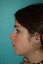 Rhinoplasty