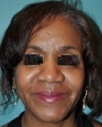 Rhinoplasty