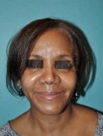 Rhinoplasty