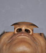 Rhinoplasty