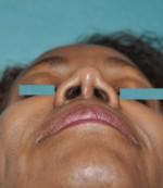 Rhinoplasty