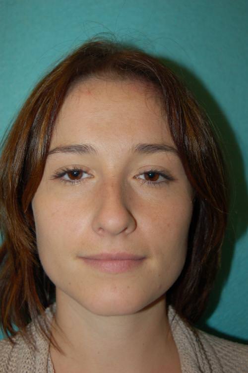 Nose Surgery Rhinoplasty Results Cincinnati