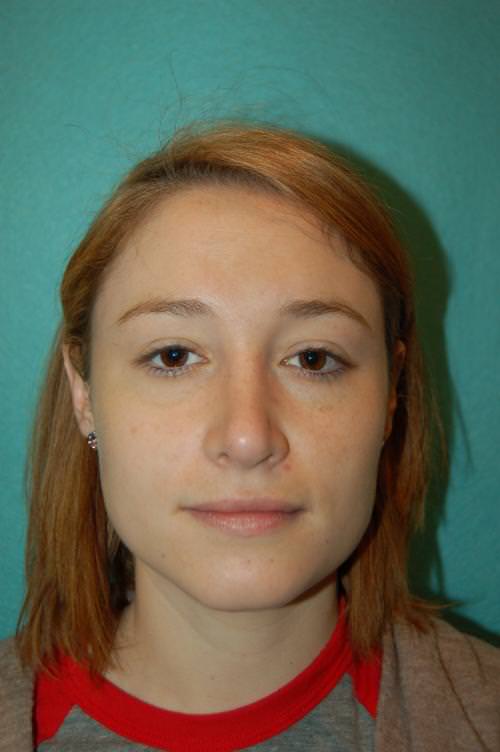 Nose Surgery Rhinoplasty Results Cincinnati