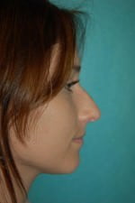 Rhinoplasty