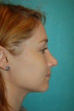 Rhinoplasty