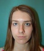 Rhinoplasty