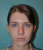 Rhinoplasty