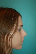 Rhinoplasty
