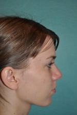 Rhinoplasty
