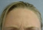 BOTOX Cosmetic