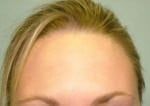 BOTOX Cosmetic