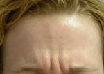 BOTOX Cosmetic