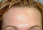 BOTOX Cosmetic