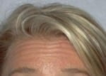 BOTOX Cosmetic