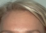 BOTOX Cosmetic