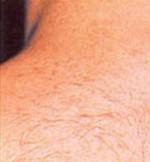 Laser Hair Removal