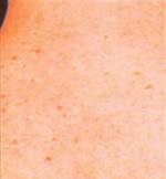 Laser Hair Removal