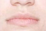 Laser Hair Removal