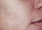 Laser Hair Removal